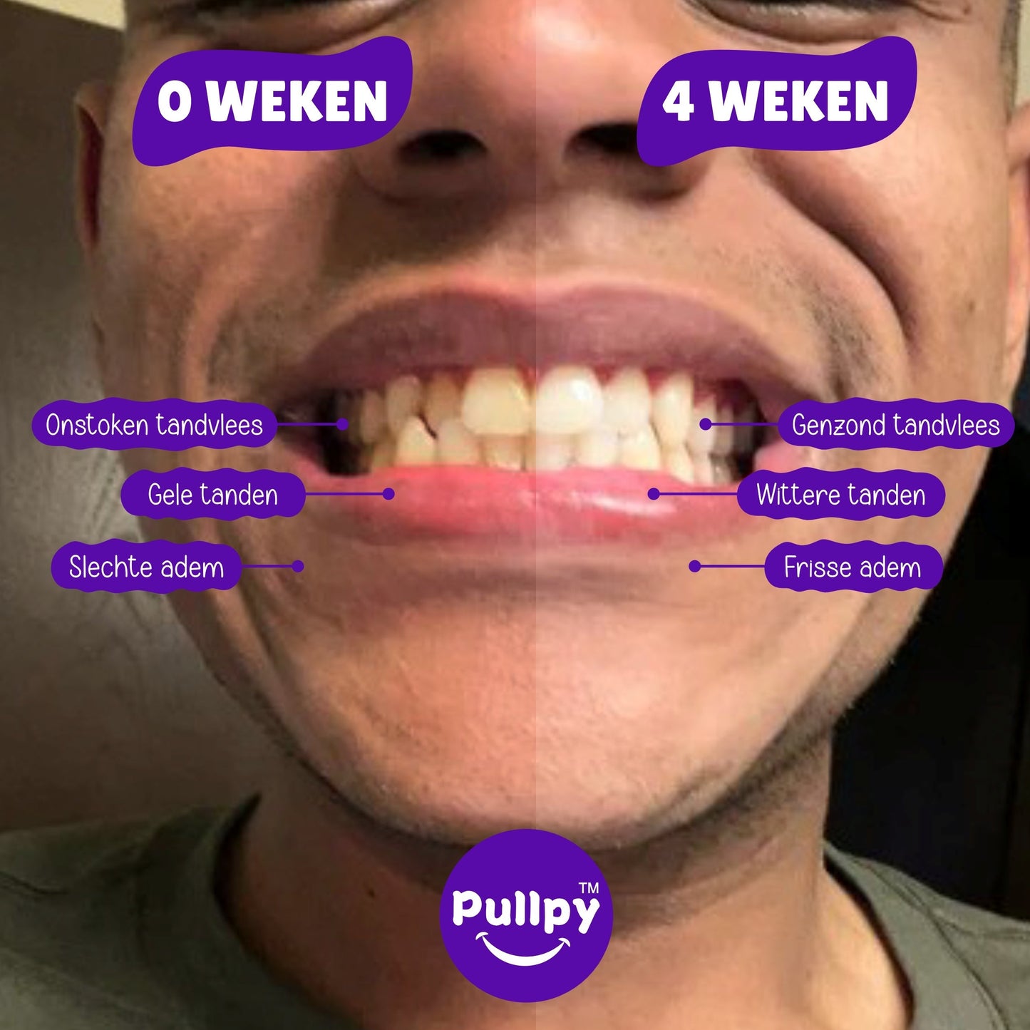 Oil Pulling Mondspoeling – Voor Sterke & Schone Tanden