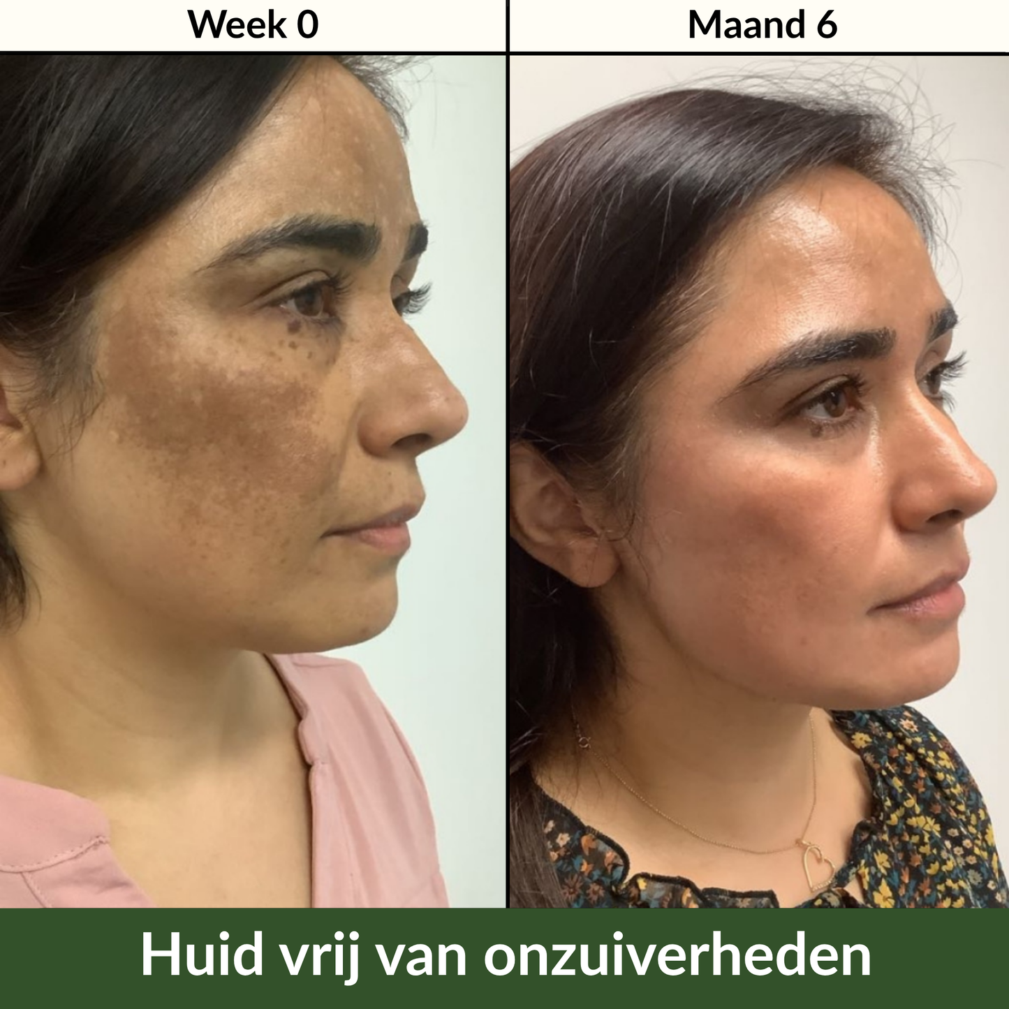 Kurkuma & Kojic Zeep voor een Egale Huid
