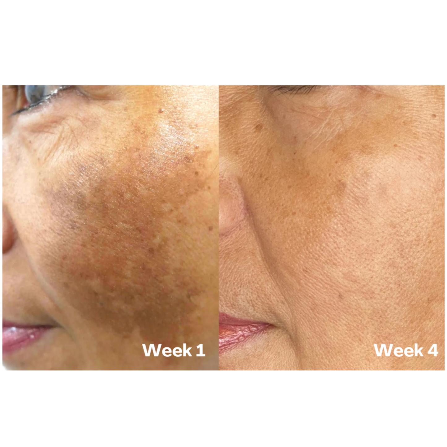 Kurkuma & Kojic Zeep voor een Egale Huid