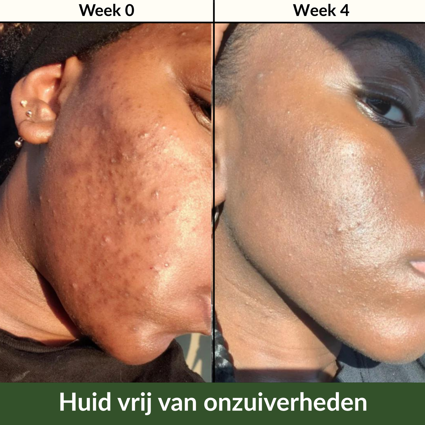 Kurkuma & Kojic Zeep voor een Egale Huid